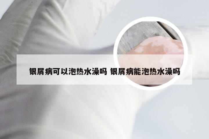 银屑病可以泡热水澡吗 银屑病能泡热水澡吗