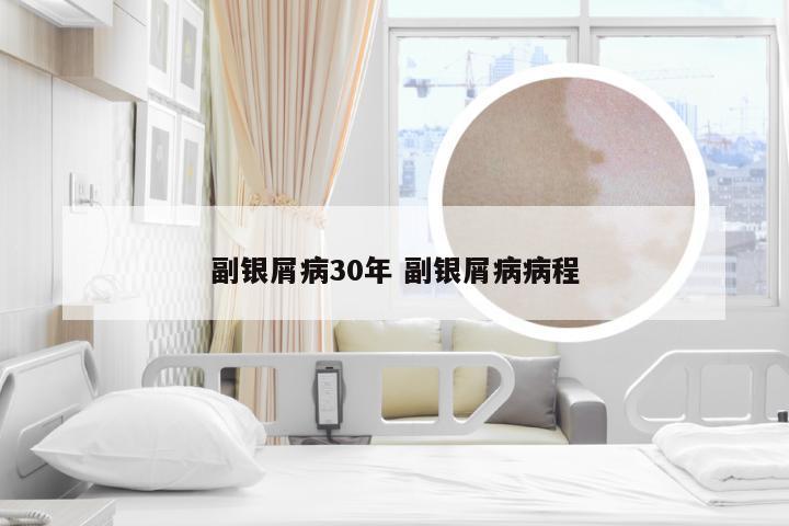 副银屑病30年 副银屑病病程