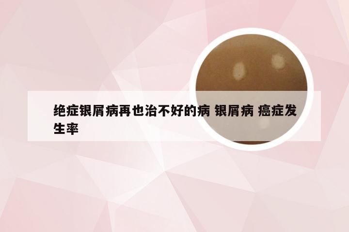 绝症银屑病再也治不好的病 银屑病 癌症发生率