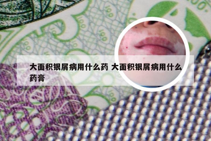 大面积银屑病用什么药 大面积银屑病用什么药膏