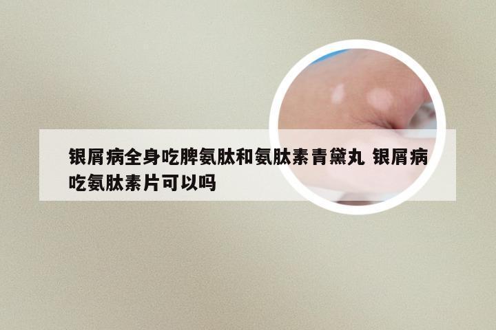 银屑病全身吃脾氨肽和氨肽素青黛丸 银屑病吃氨肽素片可以吗