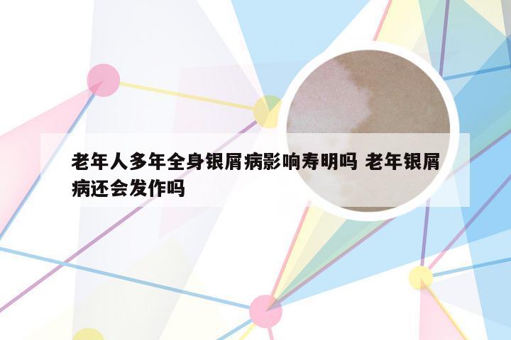 老年人多年全身银屑病影响寿明吗 老年银屑病还会发作吗
