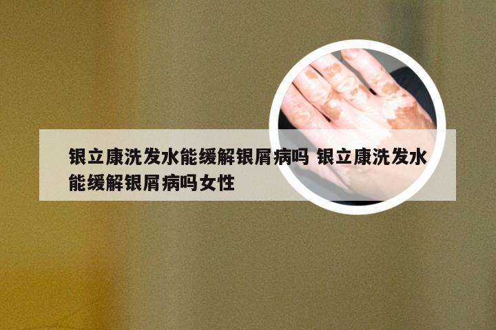 银立康洗发水能缓解银屑病吗 银立康洗发水能缓解银屑病吗女性