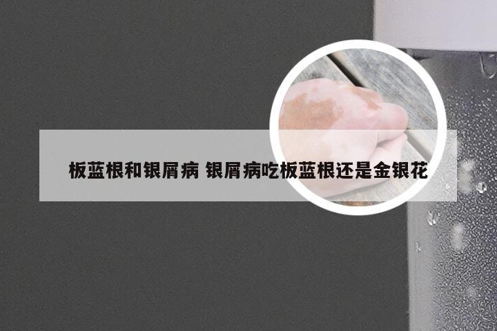 板蓝根和银屑病 银屑病吃板蓝根还是金银花