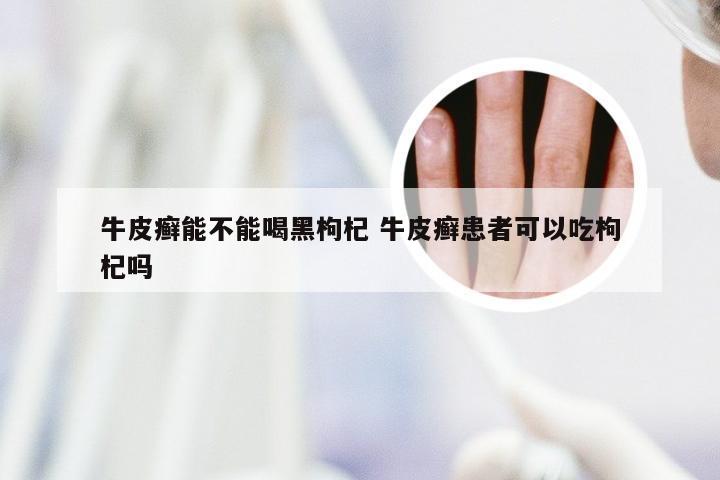 牛皮癣能不能喝黑枸杞 牛皮癣患者可以吃枸杞吗