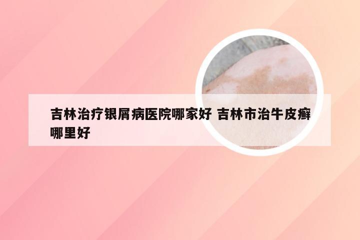 吉林治疗银屑病医院哪家好 吉林市治牛皮癣哪里好