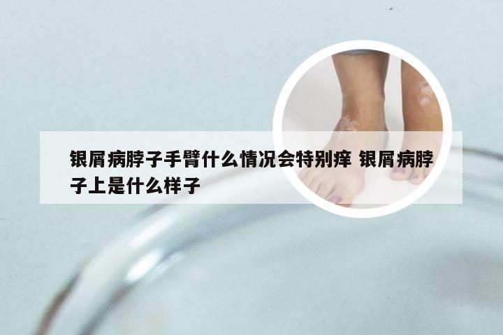 银屑病脖子手臂什么情况会特别痒 银屑病脖子上是什么样子