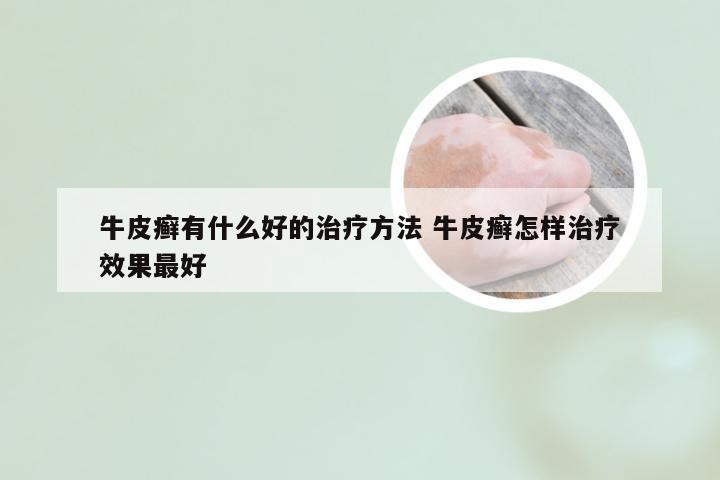 牛皮癣有什么好的治疗方法 牛皮癣怎样治疗效果最好