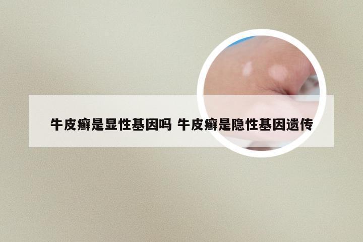 牛皮癣是显性基因吗 牛皮癣是隐性基因遗传