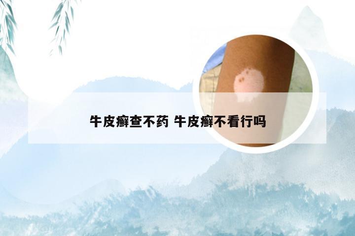 牛皮癣查不药 牛皮癣不看行吗
