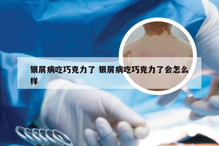 银屑病吃巧克力了 银屑病吃巧克力了会怎么样