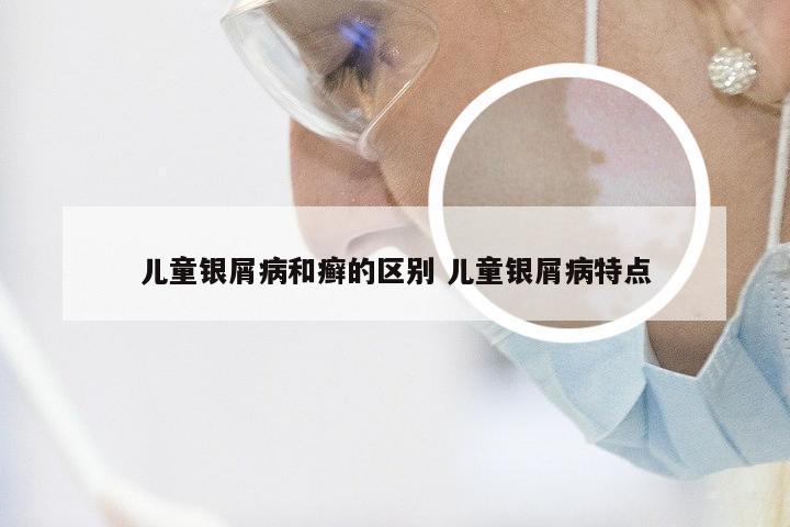 儿童银屑病和癣的区别 儿童银屑病特点