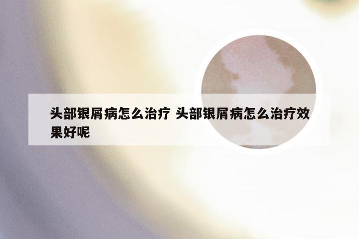 头部银屑病怎么治疗 头部银屑病怎么治疗效果好呢