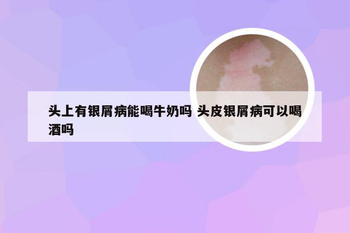 头上有银屑病能喝牛奶吗 头皮银屑病可以喝酒吗
