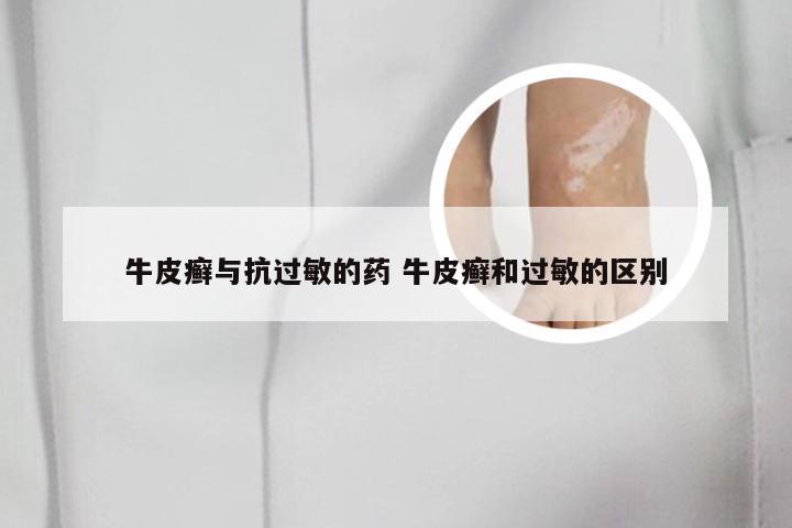 牛皮癣与抗过敏的药 牛皮癣和过敏的区别