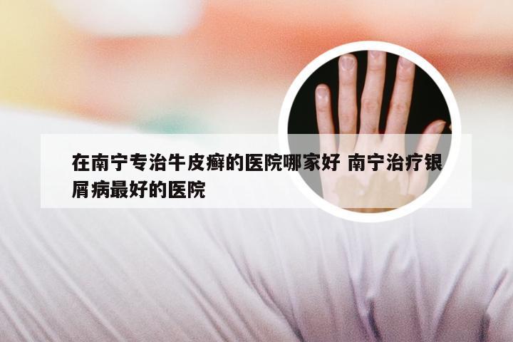 在南宁专治牛皮癣的医院哪家好 南宁治疗银屑病最好的医院