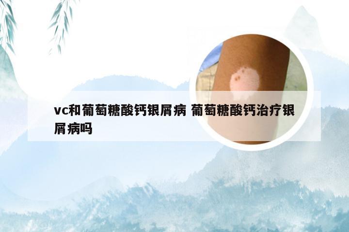 vc和葡萄糖酸钙银屑病 葡萄糖酸钙治疗银屑病吗
