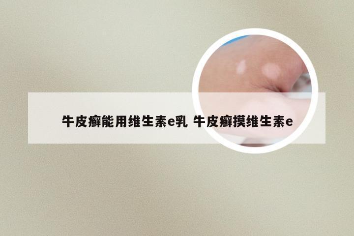 牛皮癣能用维生素e乳 牛皮癣摸维生素e