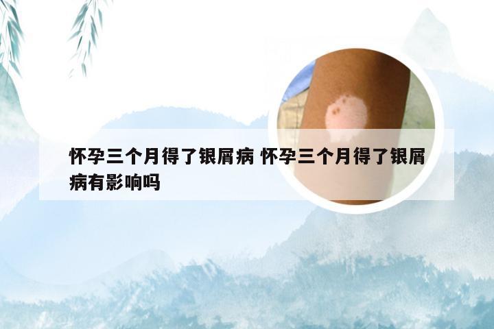 怀孕三个月得了银屑病 怀孕三个月得了银屑病有影响吗