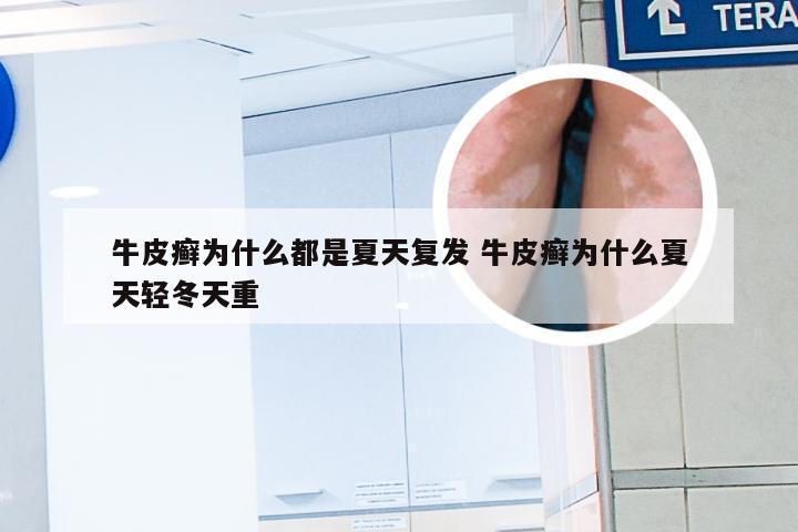 牛皮癣为什么都是夏天复发 牛皮癣为什么夏天轻冬天重