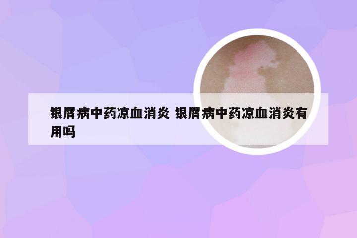 银屑病中药凉血消炎 银屑病中药凉血消炎有用吗