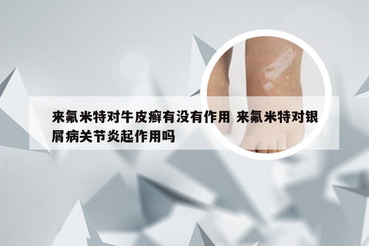 来氟米特对牛皮癣有没有作用 来氟米特对银屑病关节炎起作用吗