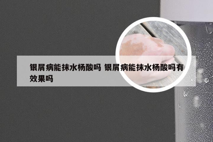 银屑病能抹水杨酸吗 银屑病能抹水杨酸吗有效果吗