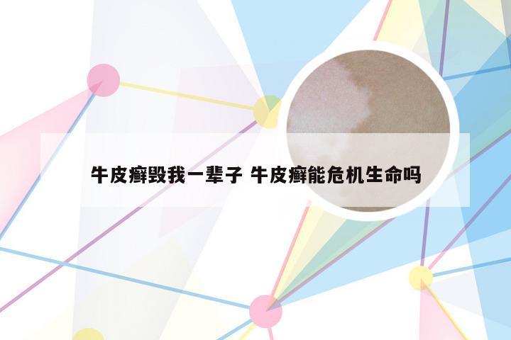 牛皮癣毁我一辈子 牛皮癣能危机生命吗