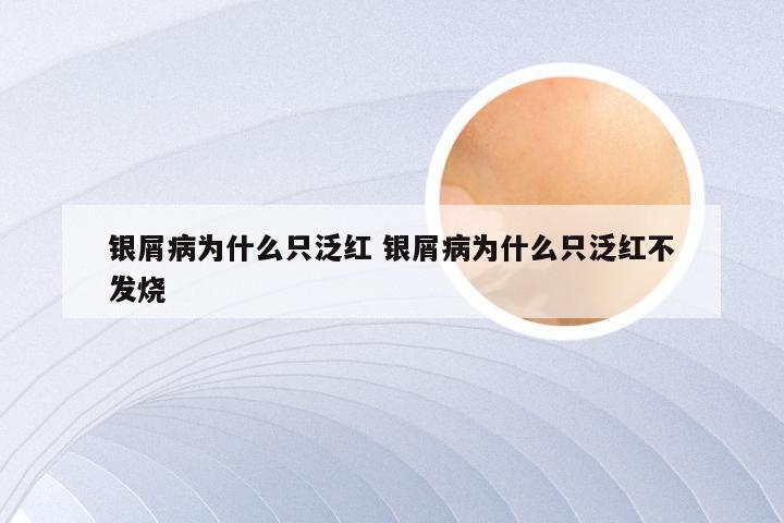 银屑病为什么只泛红 银屑病为什么只泛红不发烧