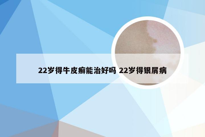 22岁得牛皮癣能治好吗 22岁得银屑病