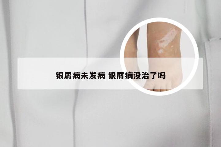 银屑病未发病 银屑病没治了吗
