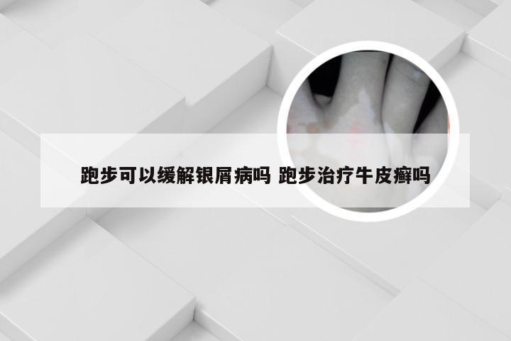 跑步可以缓解银屑病吗 跑步治疗牛皮癣吗