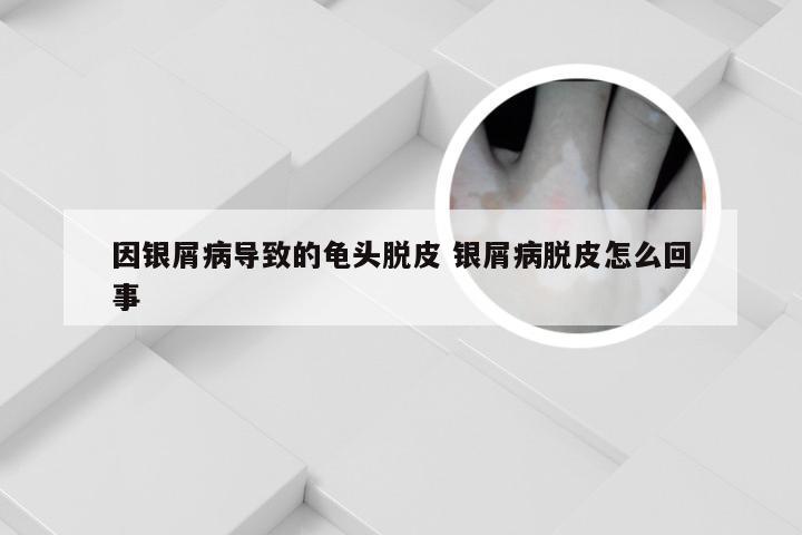 因银屑病导致的龟头脱皮 银屑病脱皮怎么回事