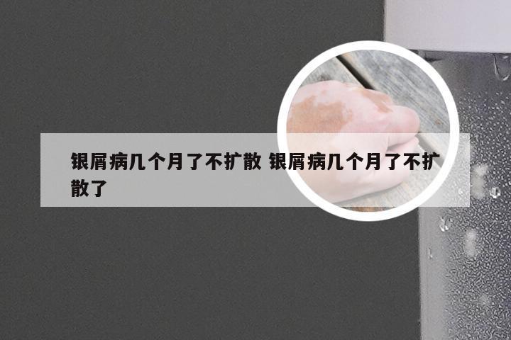 银屑病几个月了不扩散 银屑病几个月了不扩散了