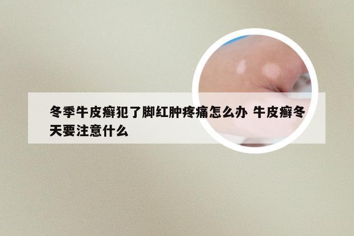 冬季牛皮癣犯了脚红肿疼痛怎么办 牛皮癣冬天要注意什么
