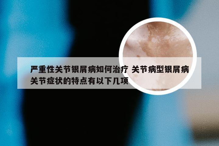 严重性关节银屑病如何治疗 关节病型银屑病关节症状的特点有以下几项
