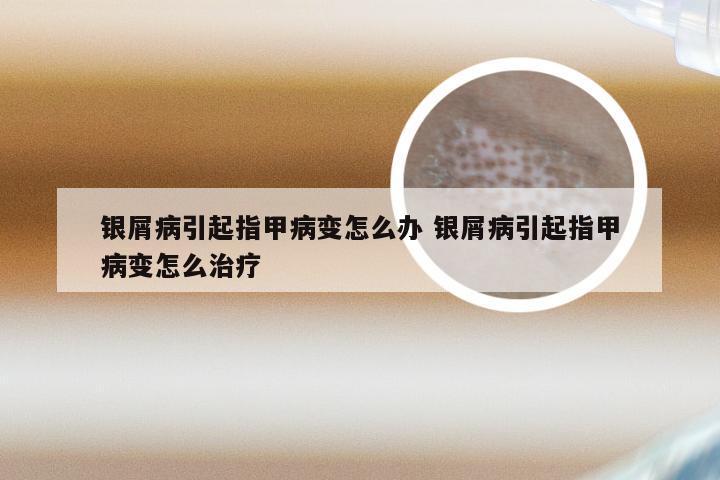 银屑病引起指甲病变怎么办 银屑病引起指甲病变怎么治疗