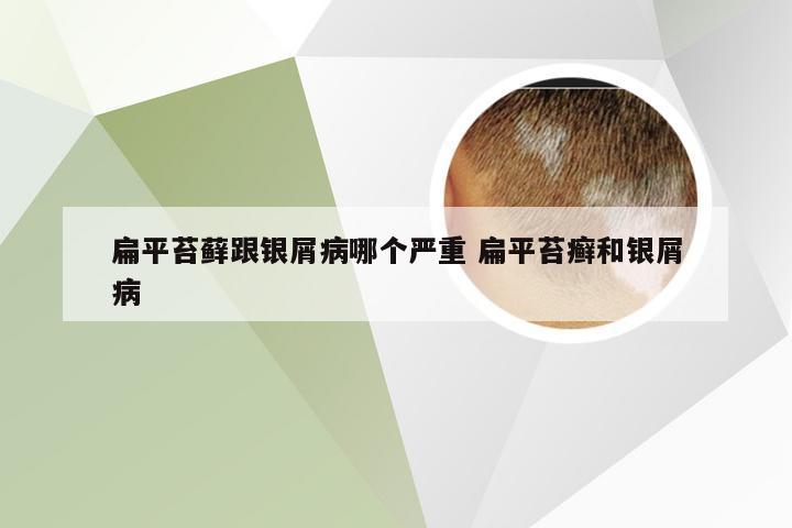 扁平苔藓跟银屑病哪个严重 扁平苔癣和银屑病