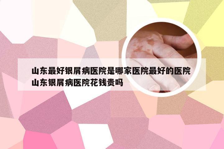 山东最好银屑病医院是哪家医院最好的医院 山东银屑病医院花钱贵吗