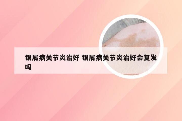 银屑病关节炎治好 银屑病关节炎治好会复发吗