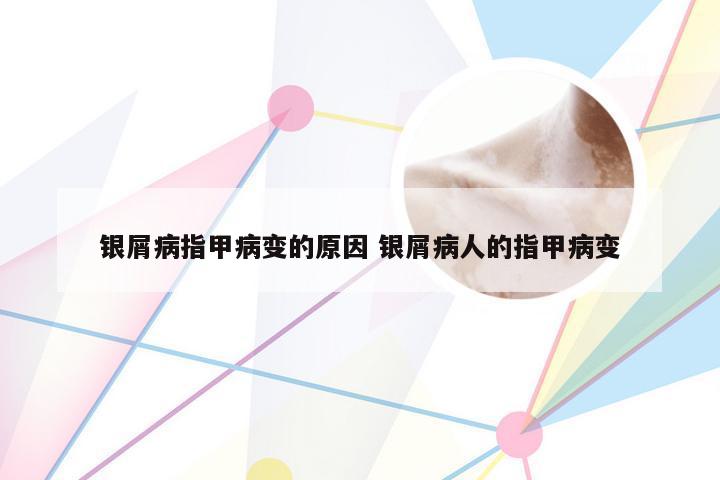 银屑病指甲病变的原因 银屑病人的指甲病变