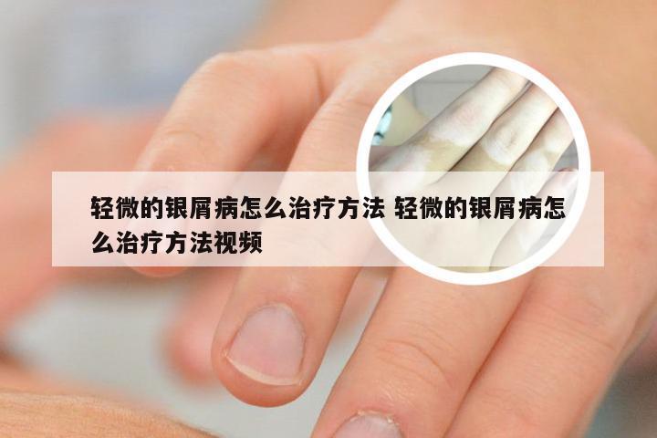 轻微的银屑病怎么治疗方法 轻微的银屑病怎么治疗方法视频