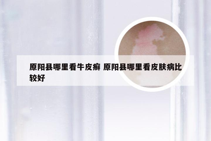 原阳县哪里看牛皮癣 原阳县哪里看皮肤病比较好