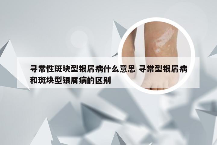 寻常性斑块型银屑病什么意思 寻常型银屑病和斑块型银屑病的区别