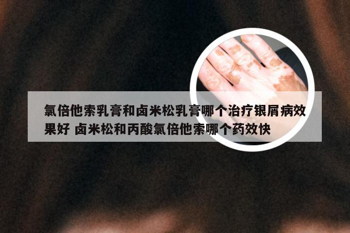 氯倍他索乳膏和卤米松乳膏哪个治疗银屑病效果好 卤米松和丙酸氯倍他索哪个药效快