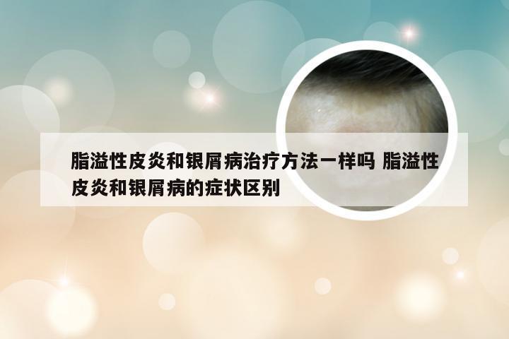 脂溢性皮炎和银屑病治疗方法一样吗 脂溢性皮炎和银屑病的症状区别