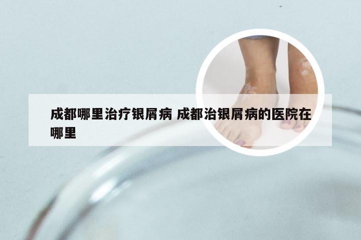 成都哪里治疗银屑病 成都治银屑病的医院在哪里
