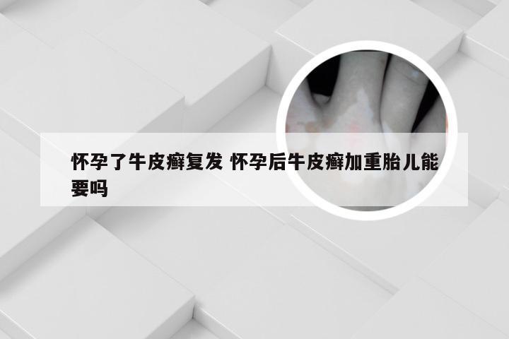 怀孕了牛皮癣复发 怀孕后牛皮癣加重胎儿能要吗