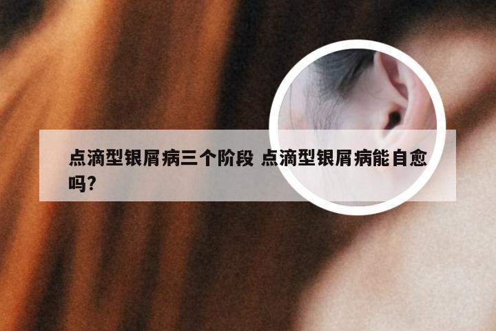 点滴型银屑病三个阶段 点滴型银屑病能自愈吗?