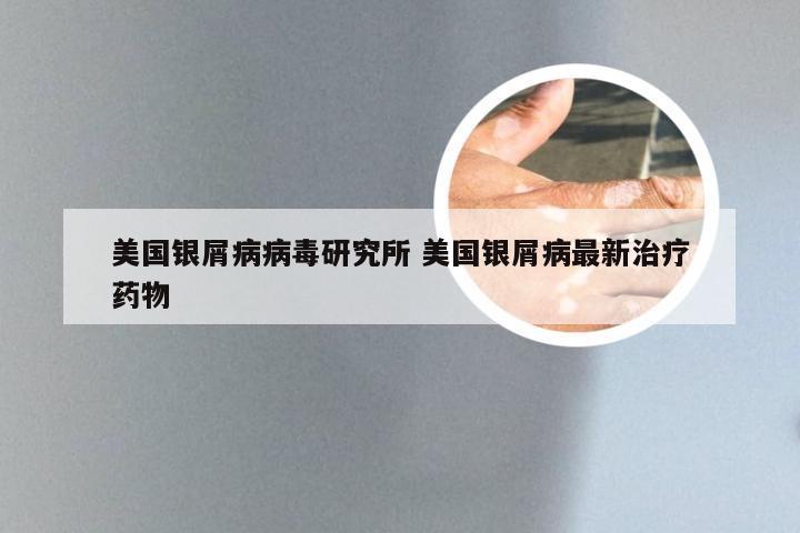 美国银屑病病毒研究所 美国银屑病最新治疗药物